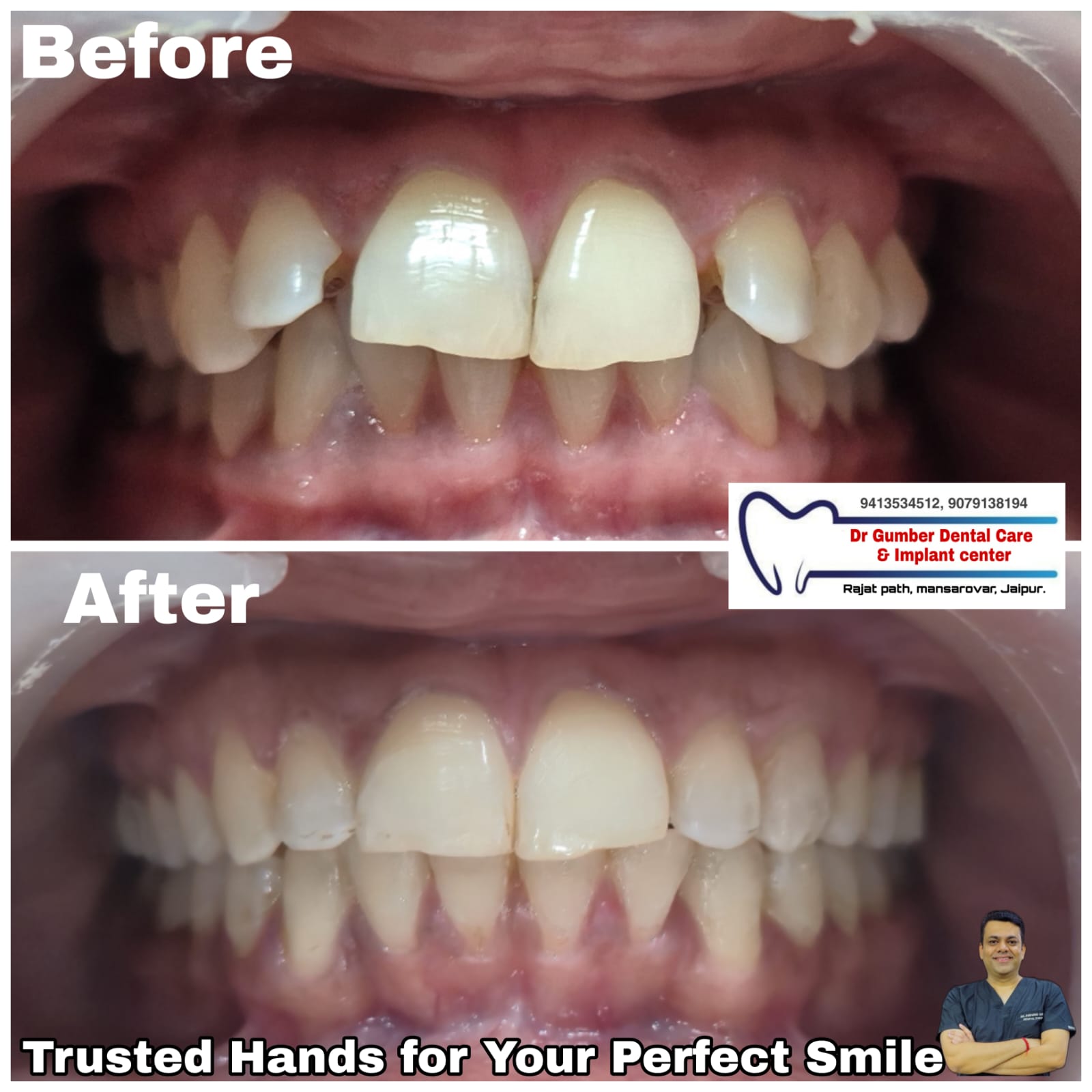 Braces & Orthodontic Treatment at Dr. Gumber Dental Clinic