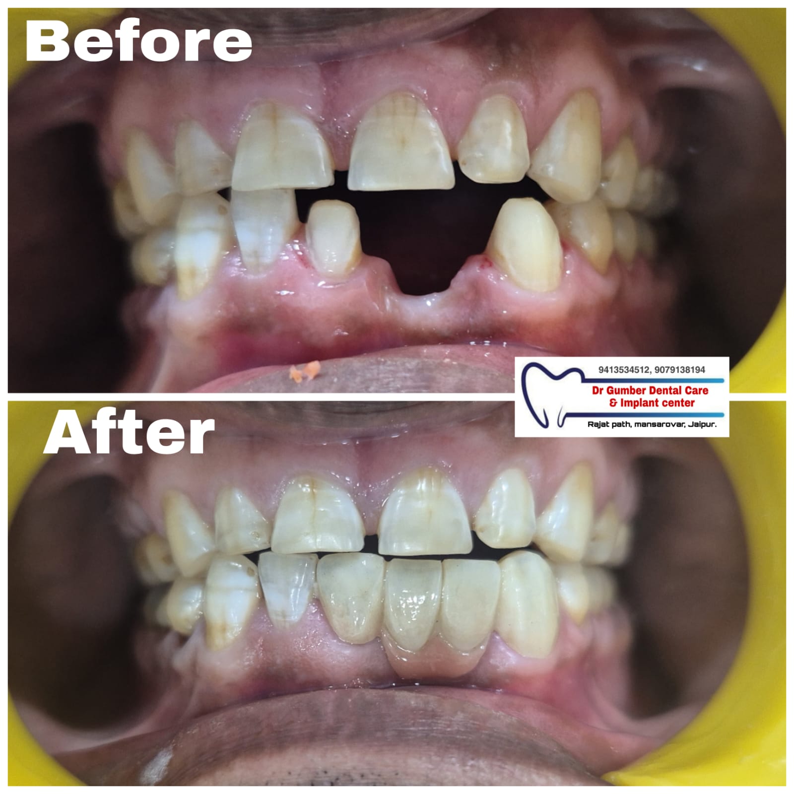 Dental Bridge at Dr. Gumber Dental Clinic