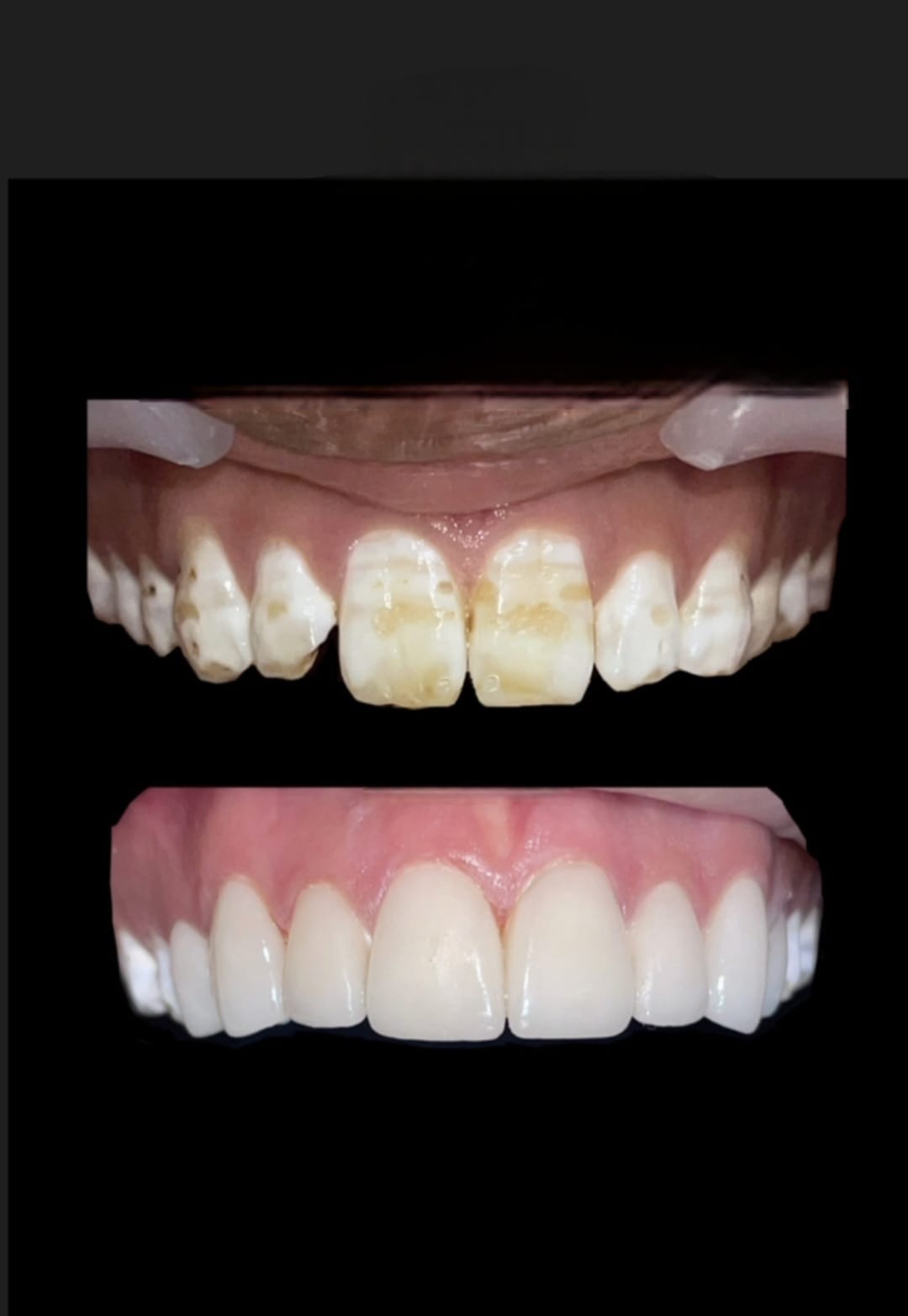 Dental Fluorosis Treatment at Dr. Gumber Dental Clinic