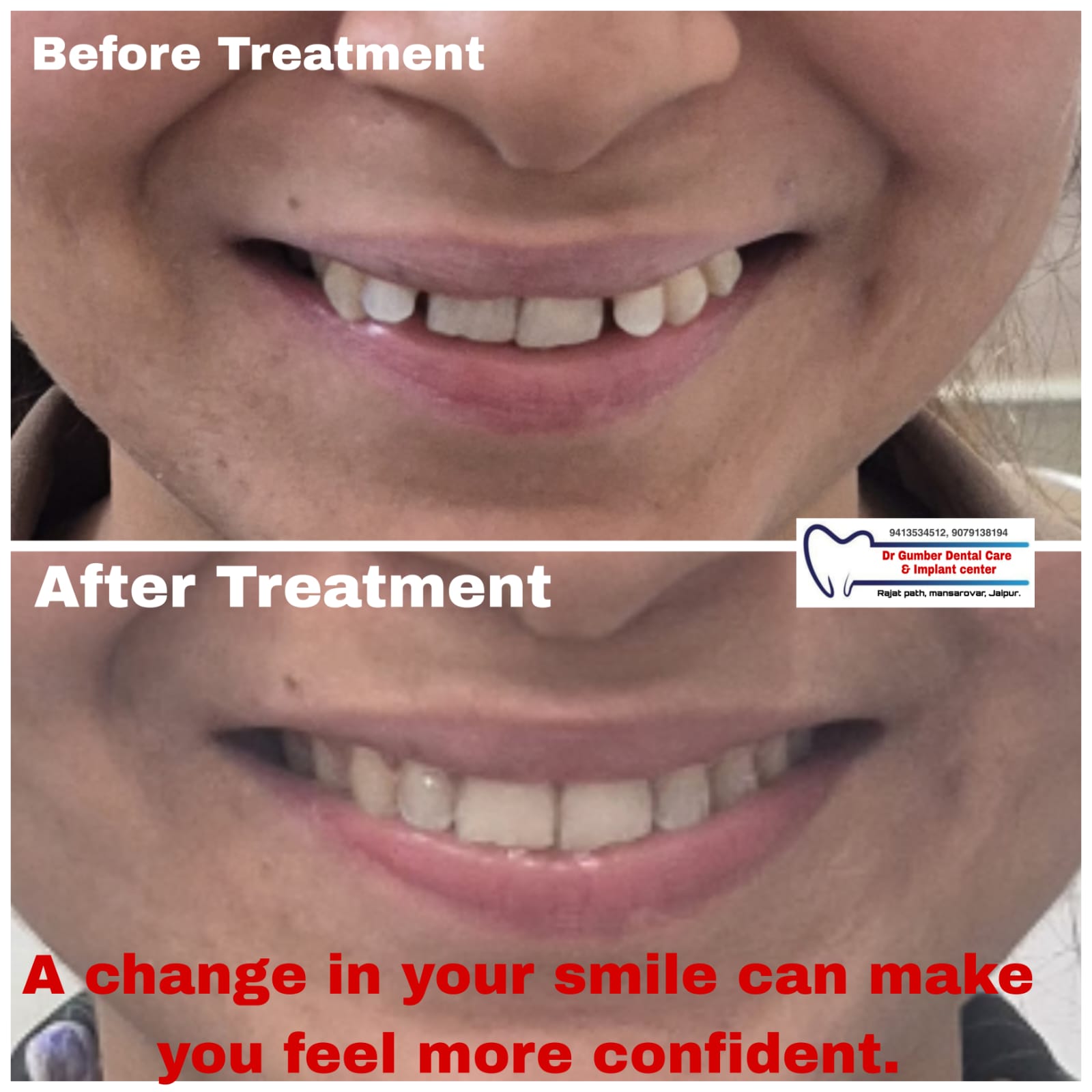Smile Makeover at Dr. Gumber Dental Clinic