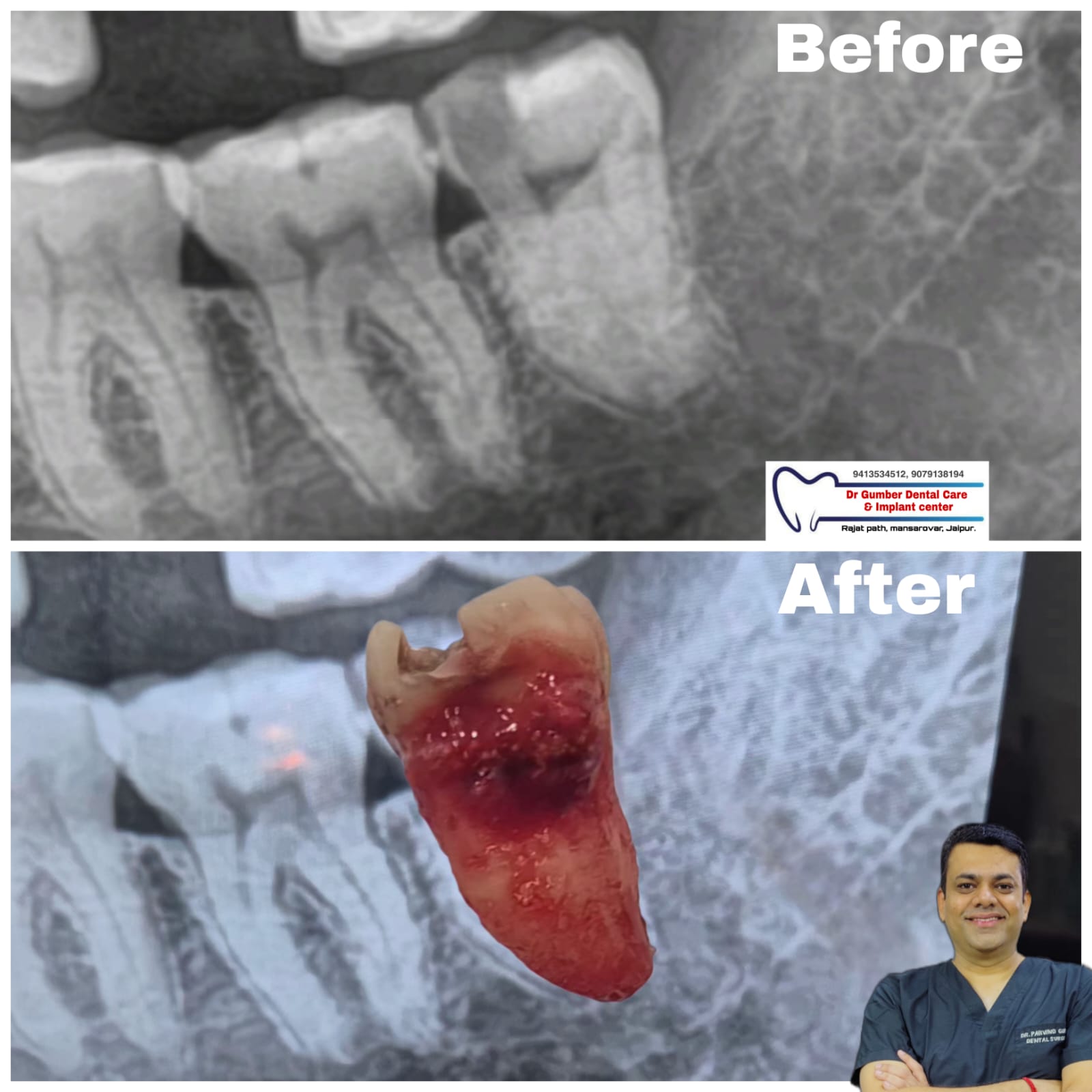 Wisdom Tooth Extraction at Dr. Gumber Dental Clinic